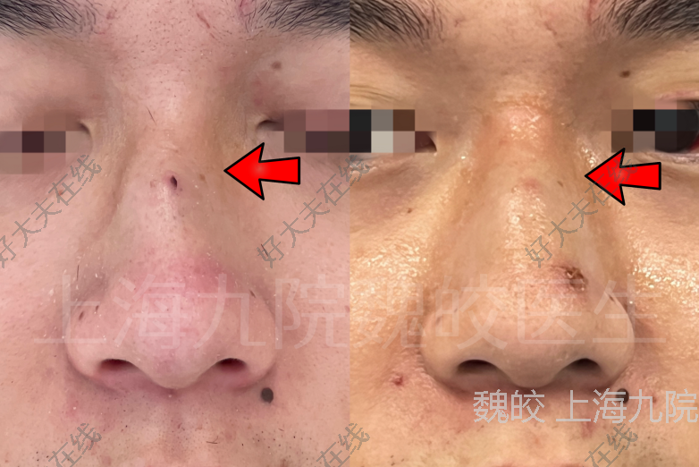 深圳新鹏城：廖力生已完成手术出院修复骨折鼻骨的简单介绍